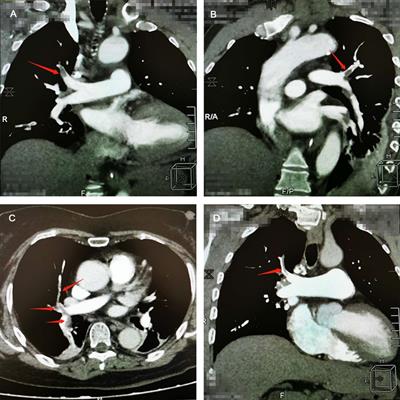 Pulmonary embolism following urological non-oncological surgery: The clinical features, management, and long-term follow-up outcome from a tertiary hospital of China
